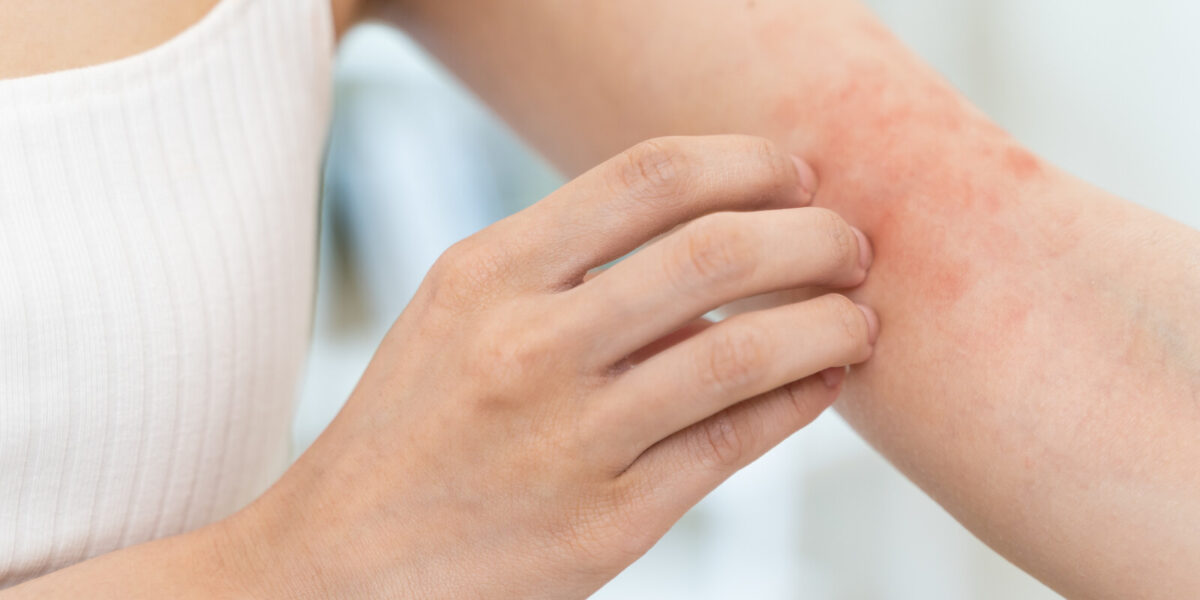 Geht Die Bräune Weg Wenn Die Haut Sich Schält Wenn die Haut juckt und sich schuppt • Naturheilpraxis